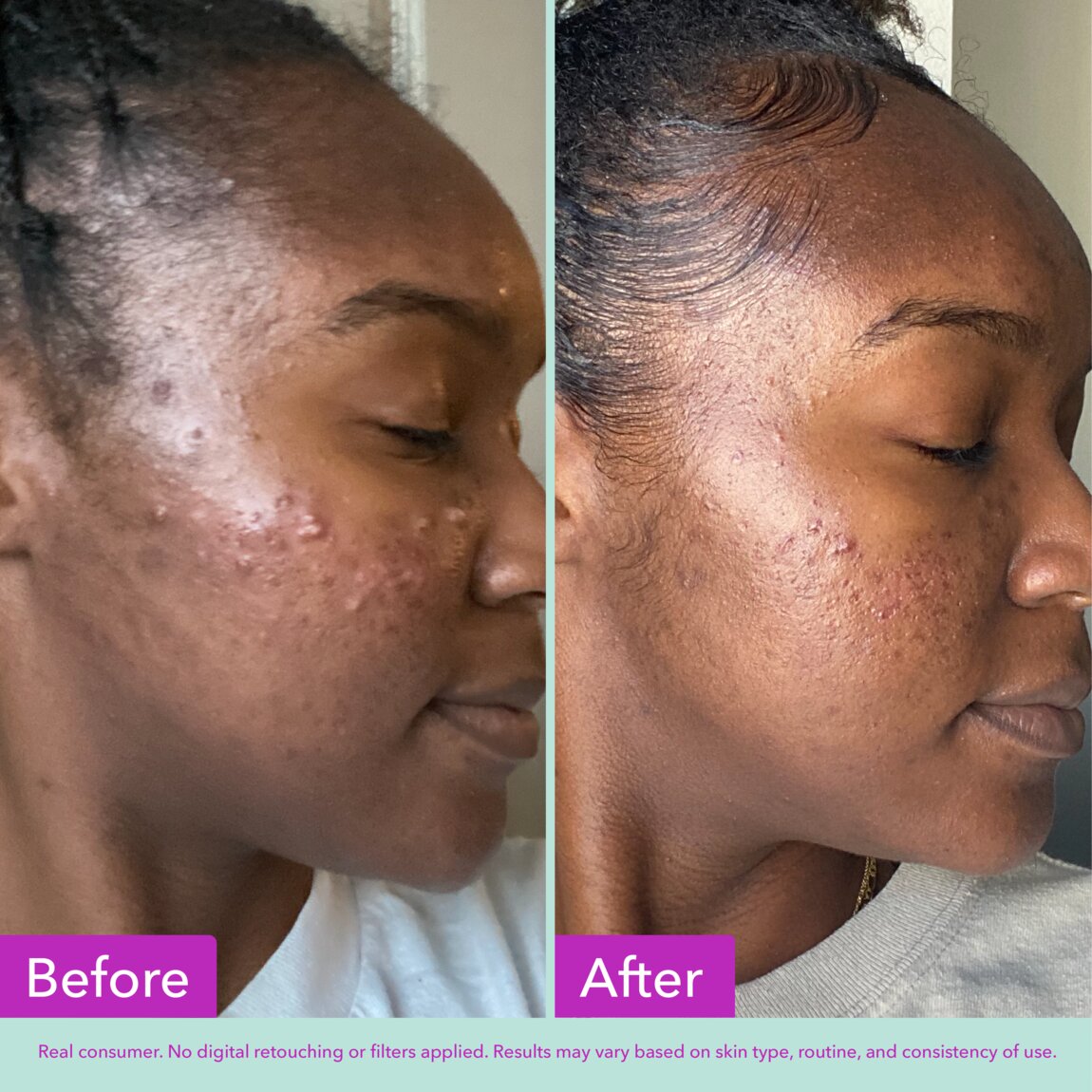 acne-foaming-cleanser-a5 zb_p.jpg
